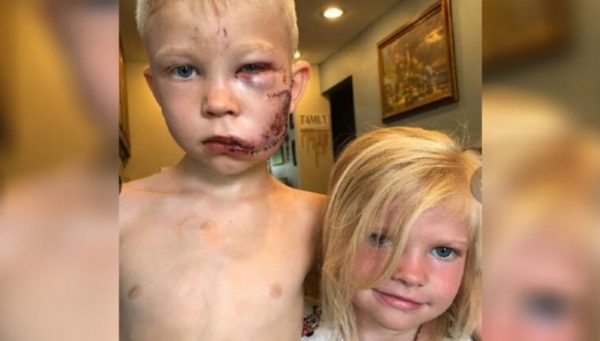 Menino de seis anos leva 90 pontos no rosto depois de salvar irmã de ataque de cachorro